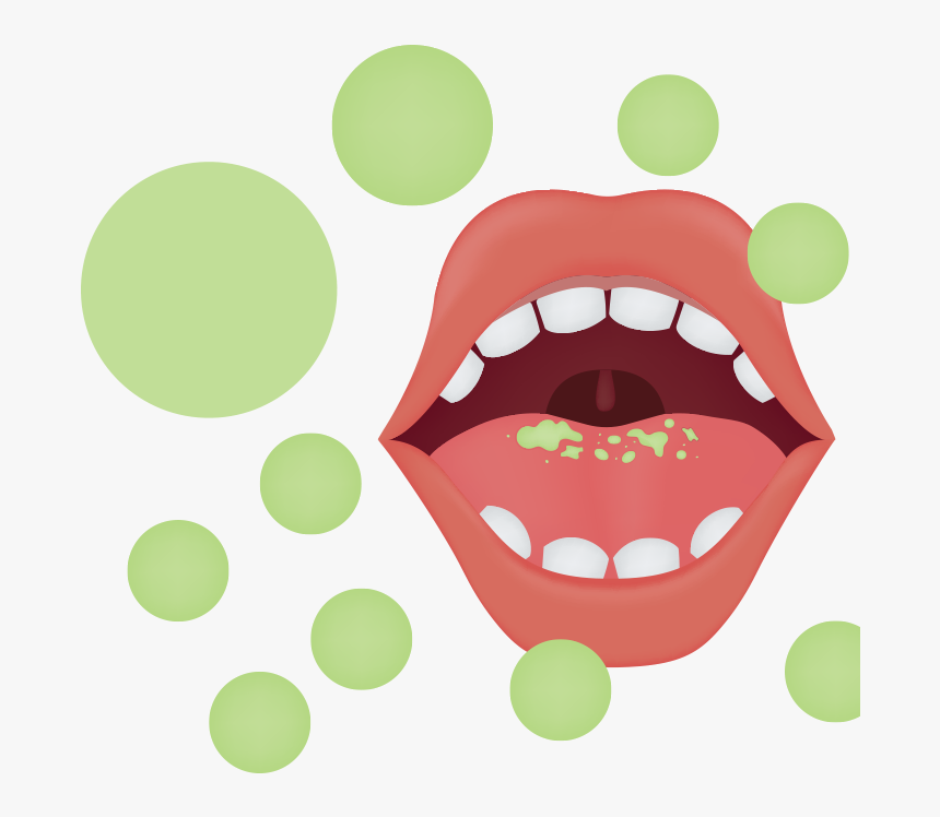 Graphic Of Mouth With Green Spots On Tongue And In - Bad Breath Cartoon Mou...