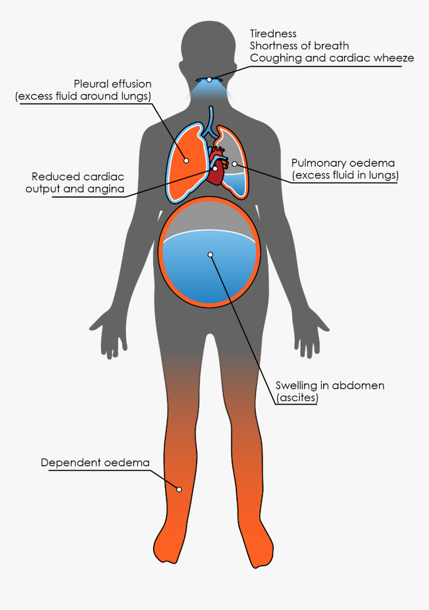 Ascites Heart Failure, HD Png Download, Free Download