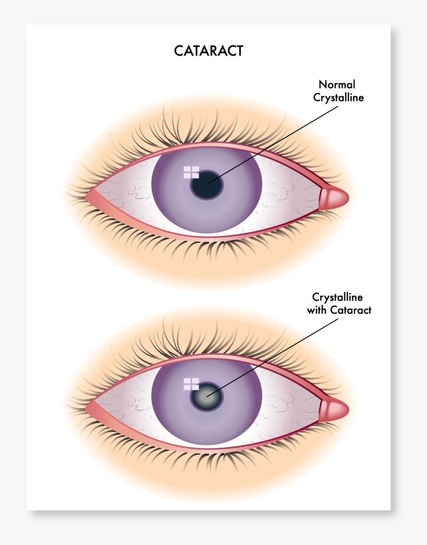 Cataract-symptoms - Cataract Symptoms, HD Png Download, Free Download