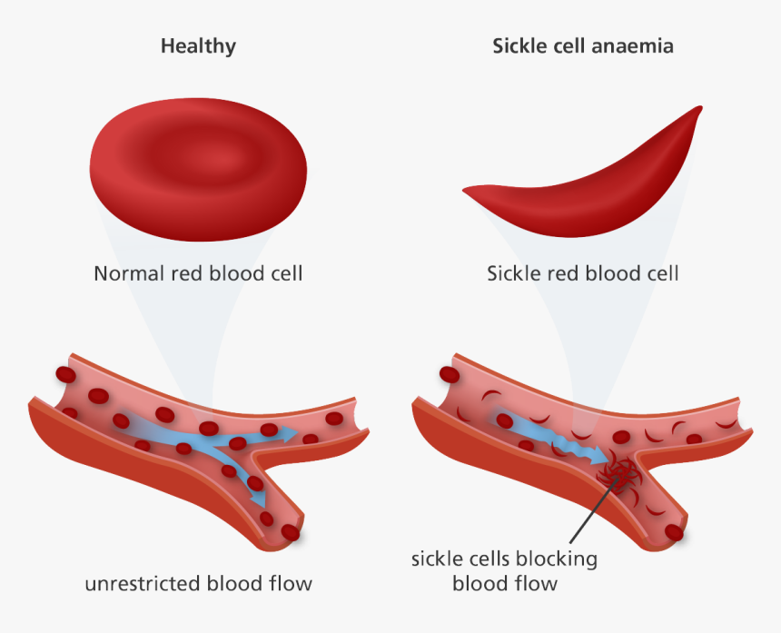 John Brown Diagnosed With Sickle Cell Trait - Red Blood Cell Sickle Cell, HD Png Download, Free Download