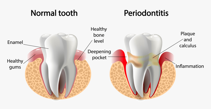 Tooth - Periodontal Disease, HD Png Download, Free Download