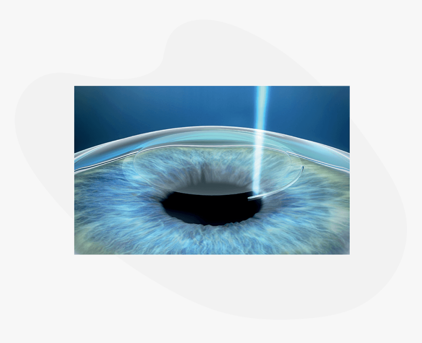 Smile Treatment Eye Preperation - Smile Surgery Eye, HD Png Download, Free Download