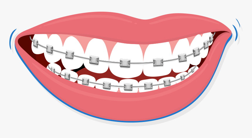 Smile With Braces Clipart, HD Png Download, Free Download