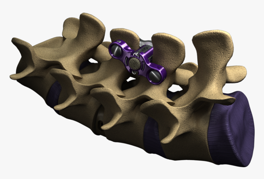 Spine Zipultra-1 - Ultra Mis Lumbar Interbody Fusion, HD Png Download, Free Download