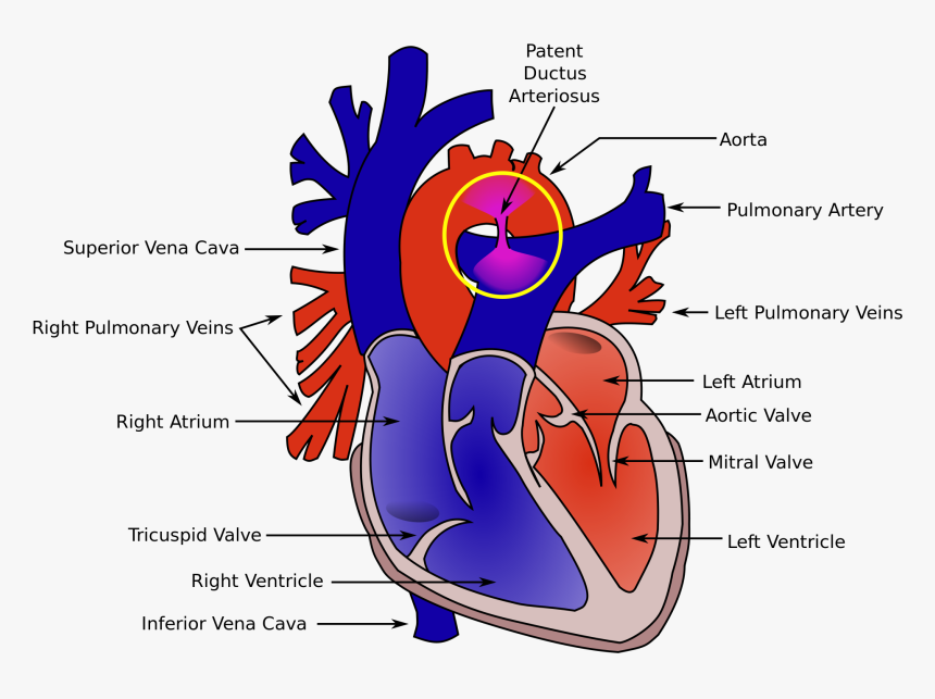 Disease Drawing Heart - Patent Ductus Arteriosus, HD Png Download, Free Download