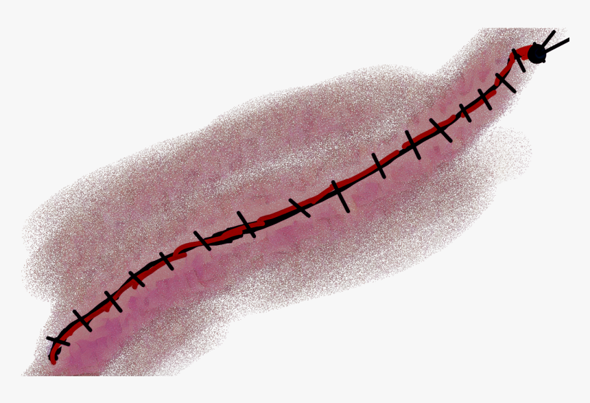 Transparent Stitch Png - Scar With Stitches Transparent, Png Download, Free Download