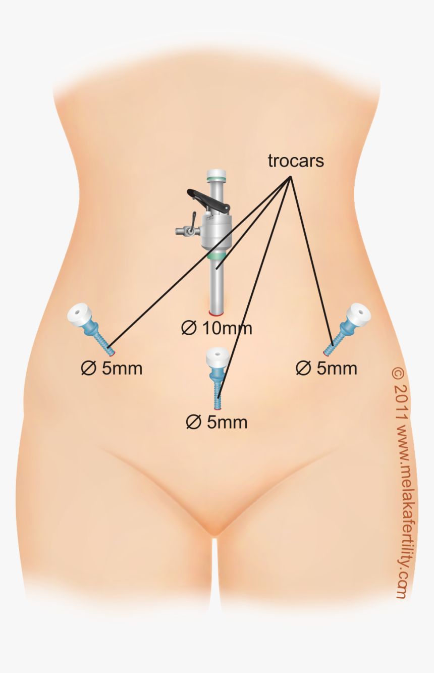 Clip Art Appendix Scar - Laparoscopic Cystectomy Scars, HD Png Download, Free Download