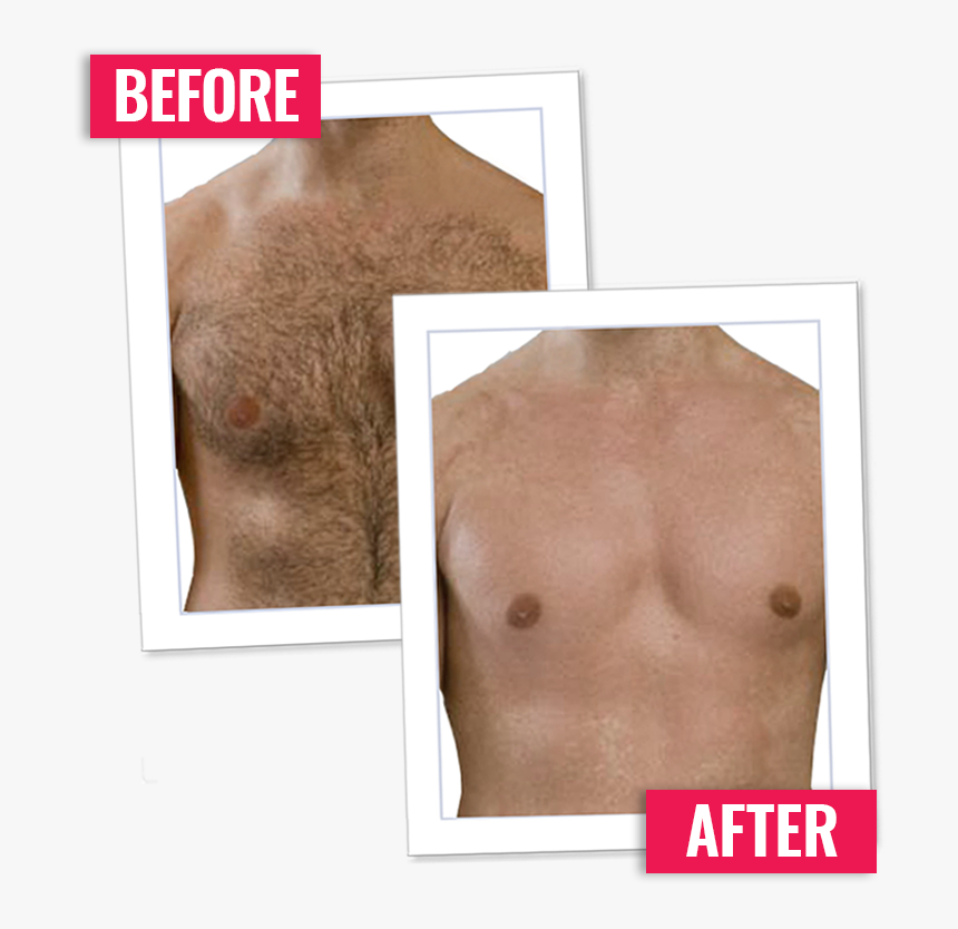 Body Hair Png - Hair Removal Men, Transparent Png, Free Download