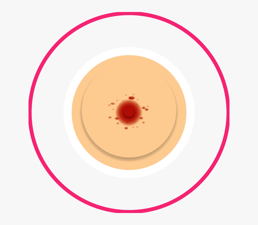 Nipple Rash - Circle, HD Png Download, Free Download