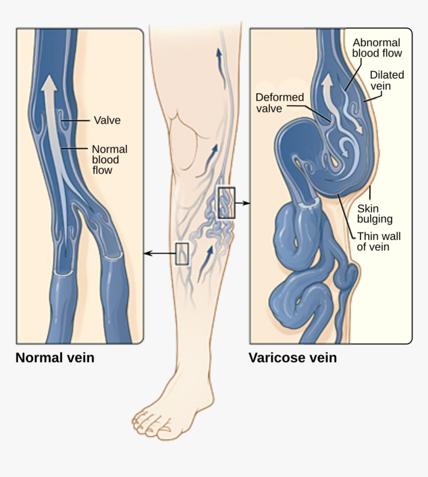 Large Varicose Veins, HD Png Download, Free Download