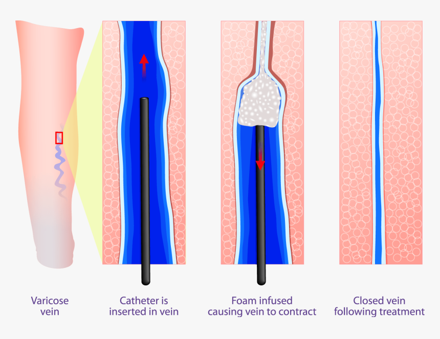 Sclerotherapy Treatment - Sclerotherapy Varicose Veins, HD Png Download, Free Download