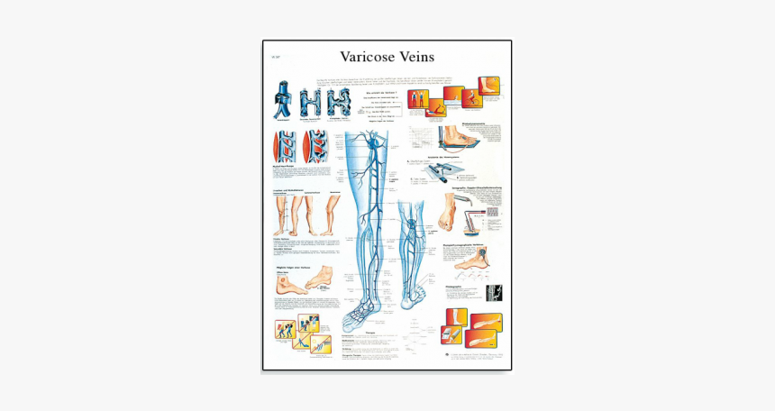 Varicose Veins Chart"
 Title="varicose Veins Chart"
 - Poster Varicose Vein, HD Png Download, Free Download