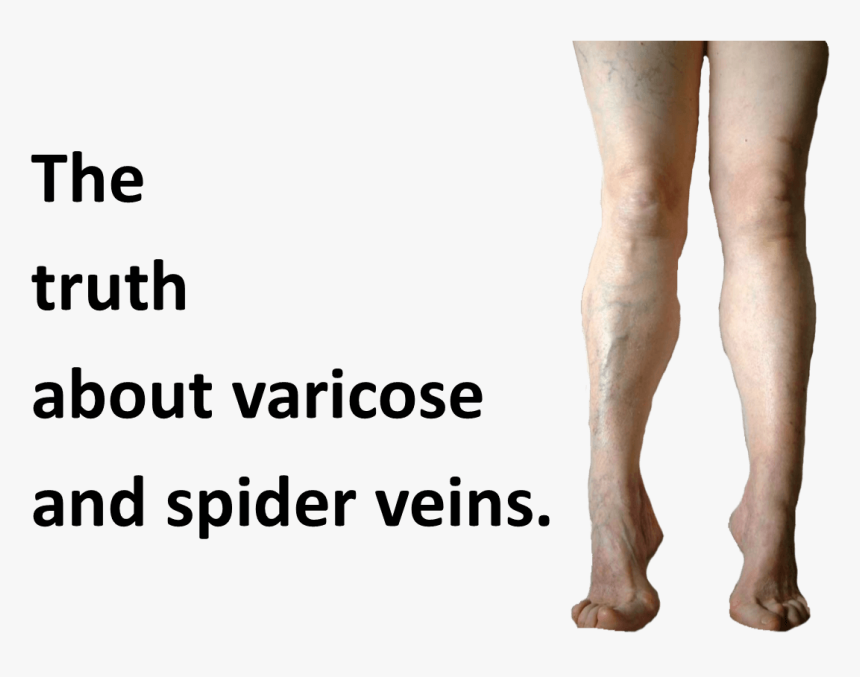 Spider Veins Photos - Tights, HD Png Download, Free Download