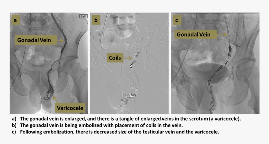 Varicocele Embolization Original - Computed Tomography, HD Png Download, Free Download