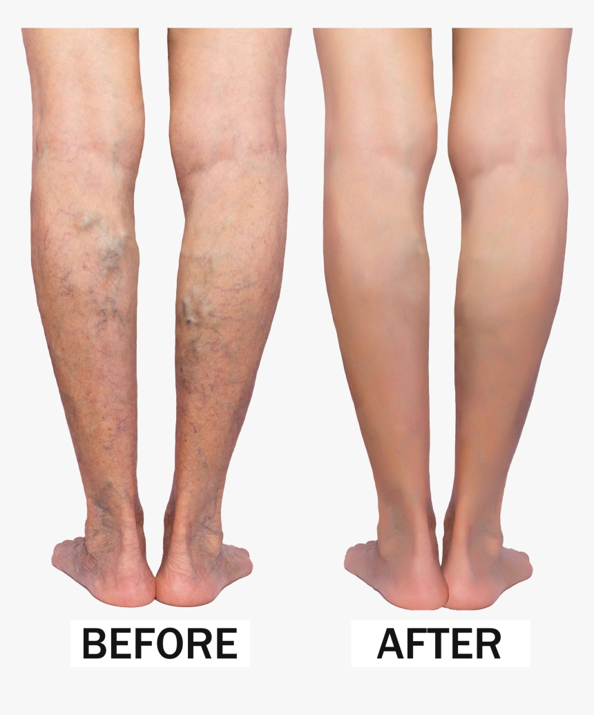 Varicose Veins Before & After - Rope Like Varicose Veins, HD Png Download, Free Download