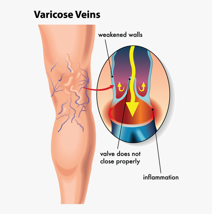 By Unsightly Veins Are Delighted With The Results They - One Way Valves Veins, HD Png Download, Free Download
