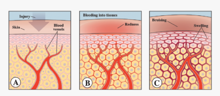 Bruise Forming, HD Png Download, Free Download