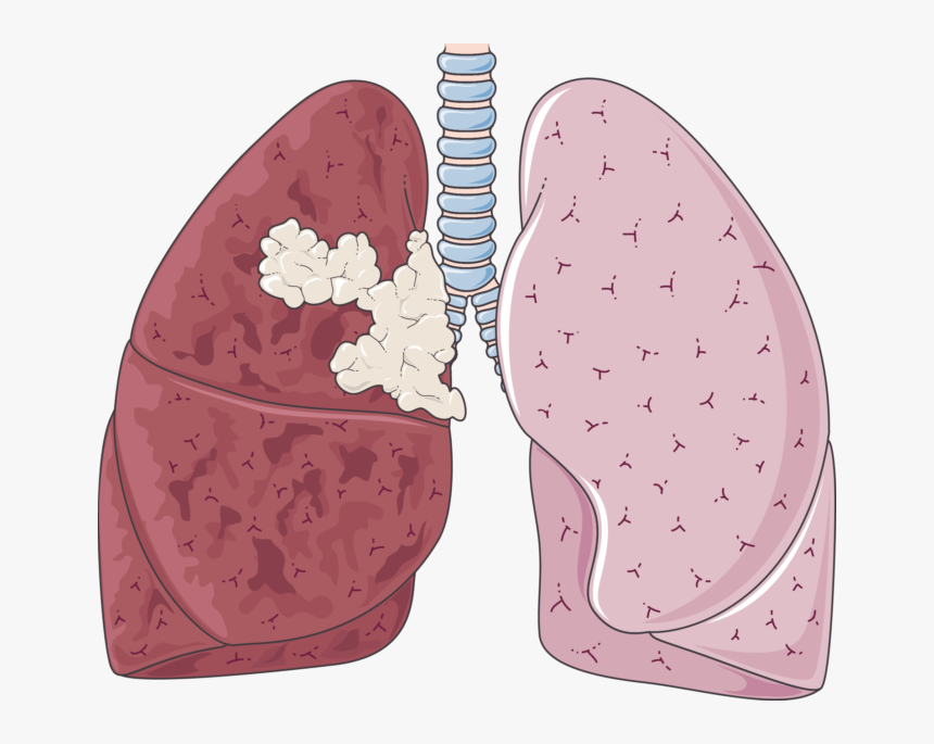 Ct Scan Of Smokers Lung, HD Png Download, Free Download