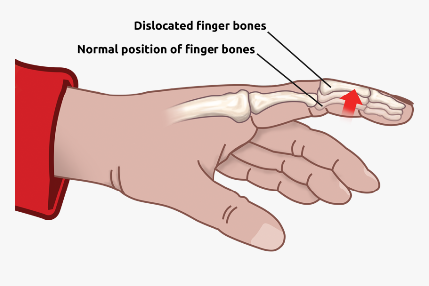 Dislocated Finger - Złamany Palec U Ręki, HD Png Download, Free Download