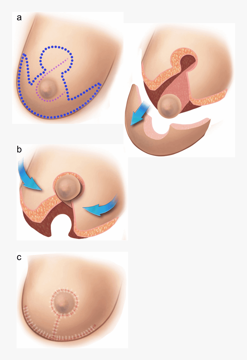 Illustration Of A Breast Reduction - Anchor Breast Reduction Surgery, HD Png Download, Free Download