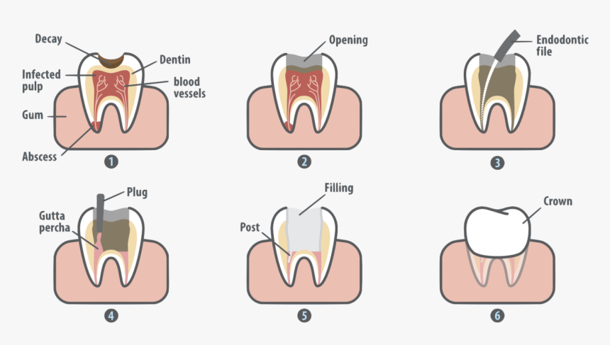 Root Canal Treatment Manassas Va - Root Canal Vs Filling, HD Png Download, Free Download