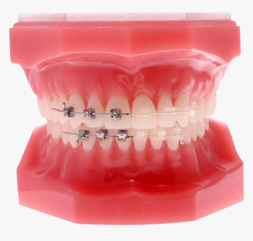 Dental-braces - Self Ligating Braces Png, Transparent Png, Free Download