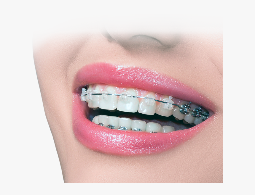 Invisalign Vs Braces - Dental Banner Images Hd, HD Png Download, Free Download