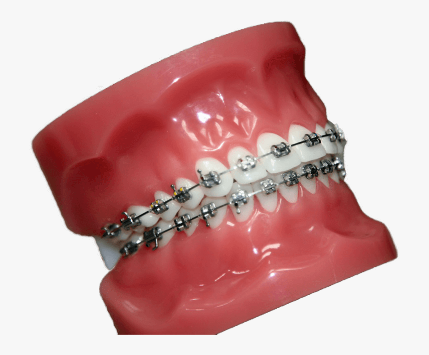 Buccal Braces - Ring, HD Png Download, Free Download