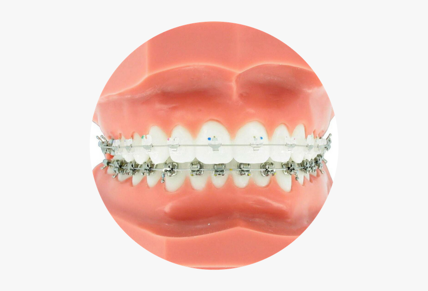 Clear Braces, HD Png Download, Free Download