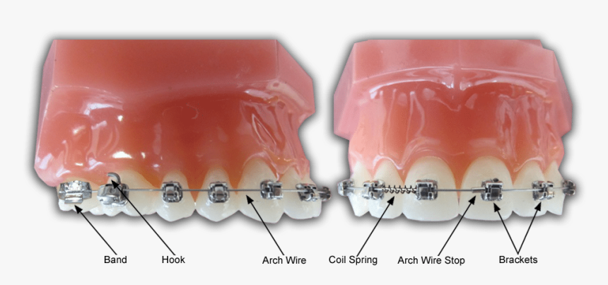 Braces Diagram - Braces Parts Names, HD Png Download, Free Download