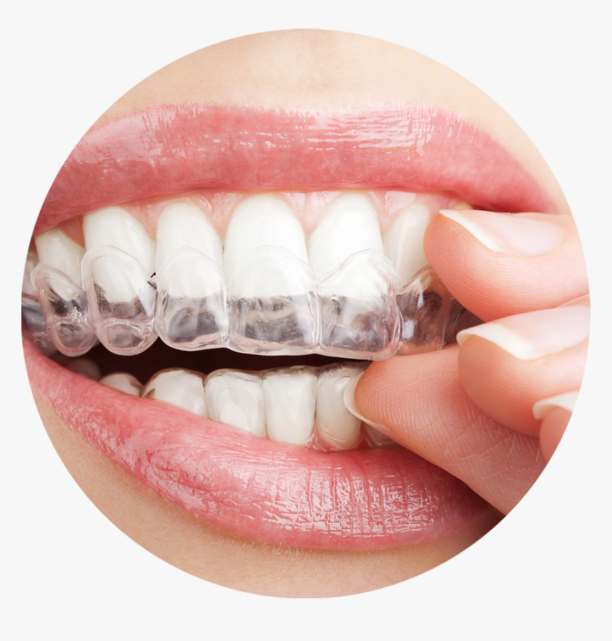 Transparent Teeth With Braces Clipart - Treatment For Teeth, HD Png Download, Free Download