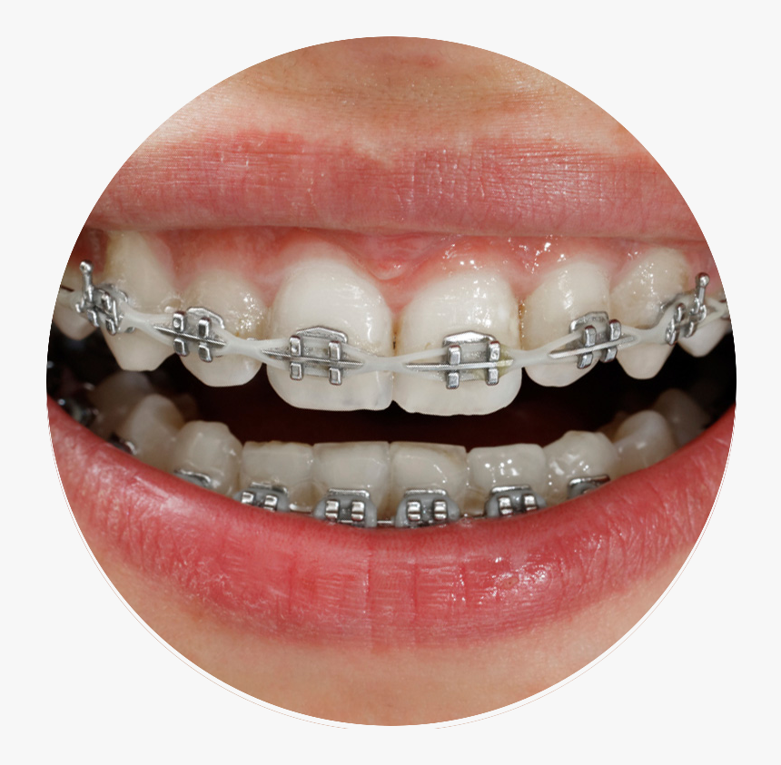 White Braces Power Chain, HD Png Download, Free Download