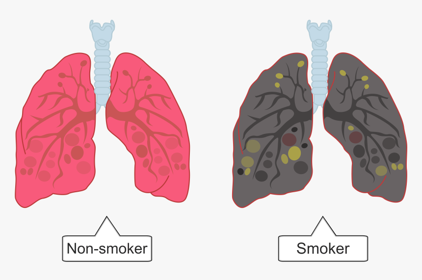 In The Lungs, The Cells That Line The Bronchi Produce - Smokers Lungs Png Transparent, Png Download, Free Download