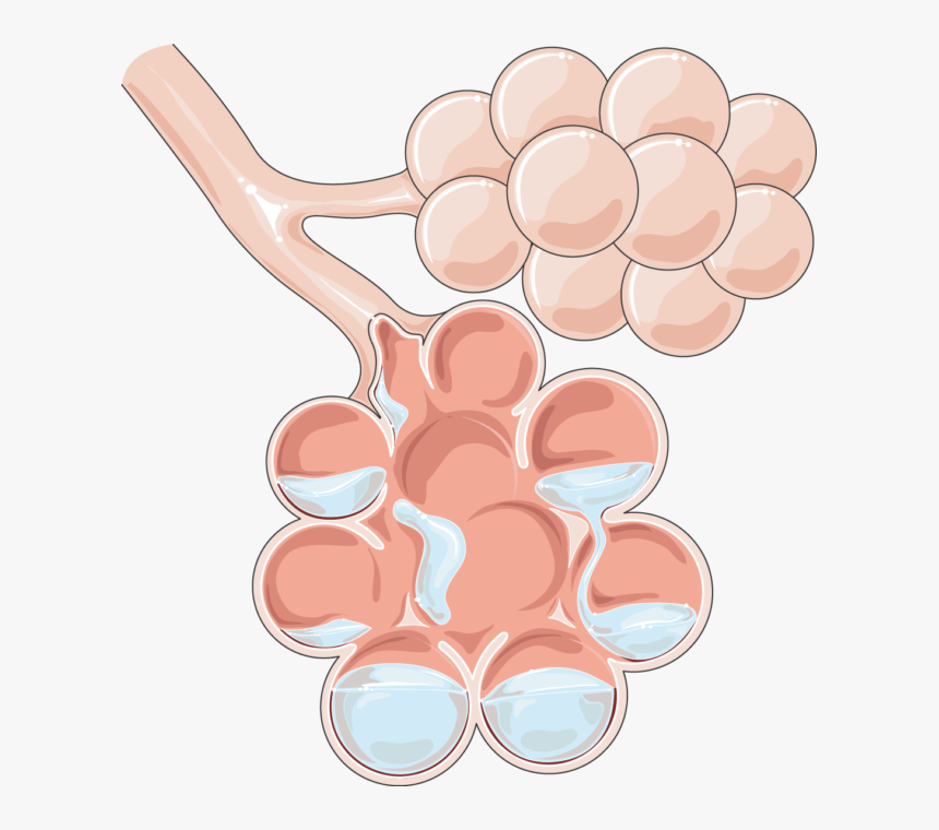 Pulmonary Edema, HD Png Download, Free Download