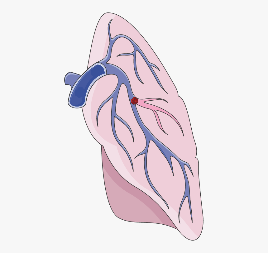 Lungs Clipart Pulmonary Embolism - Pulmonary Embolism Clipart, HD Png Download, Free Download