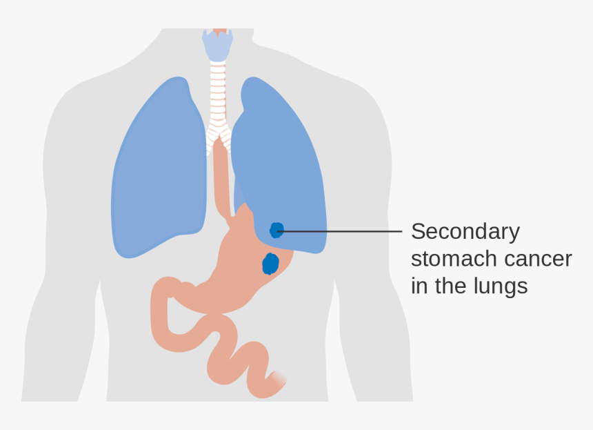 Diagram Showing Secondary Stomach Cancer In The Lungs - Stomach Lung, HD Png Download, Free Download