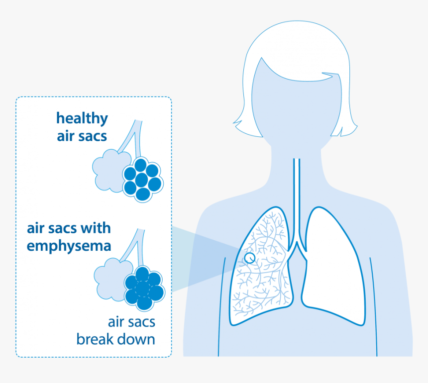 Diagram Of Lungs With Emphysema - Lung Reduction Surgery Copd, HD Png Download, Free Download