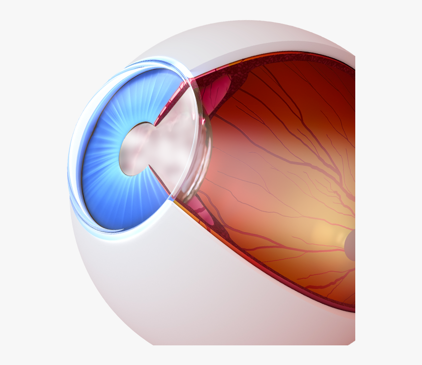 Diagram Of An Eye With Cataracts - Sphere, HD Png Download, Free Download