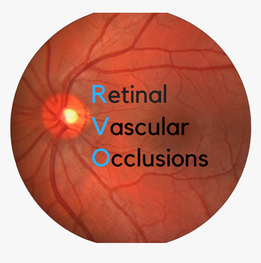 Rvo Retinopathy, HD Png Download, Free Download