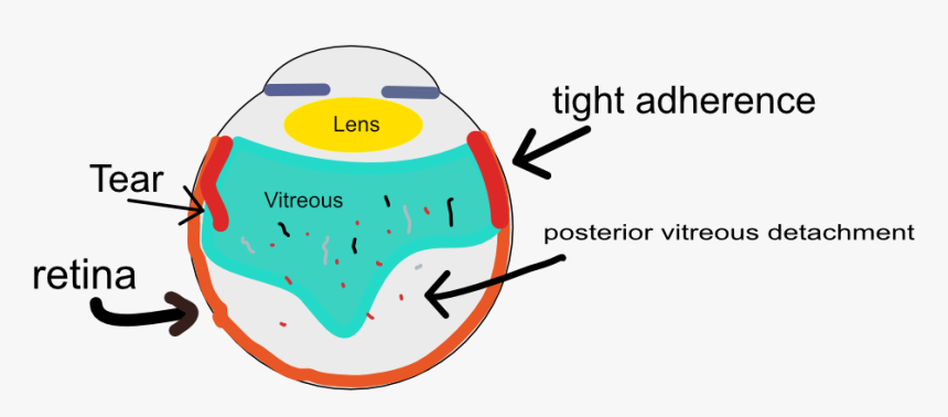 Flashes Vitreous Tug, HD Png Download, Free Download