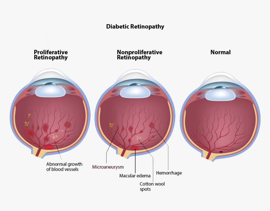 Diabetic Eyes, HD Png Download, Free Download