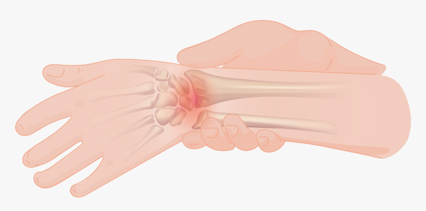 Wrist Pain - Climbing Wrist Injury, HD Png Download, Free Download