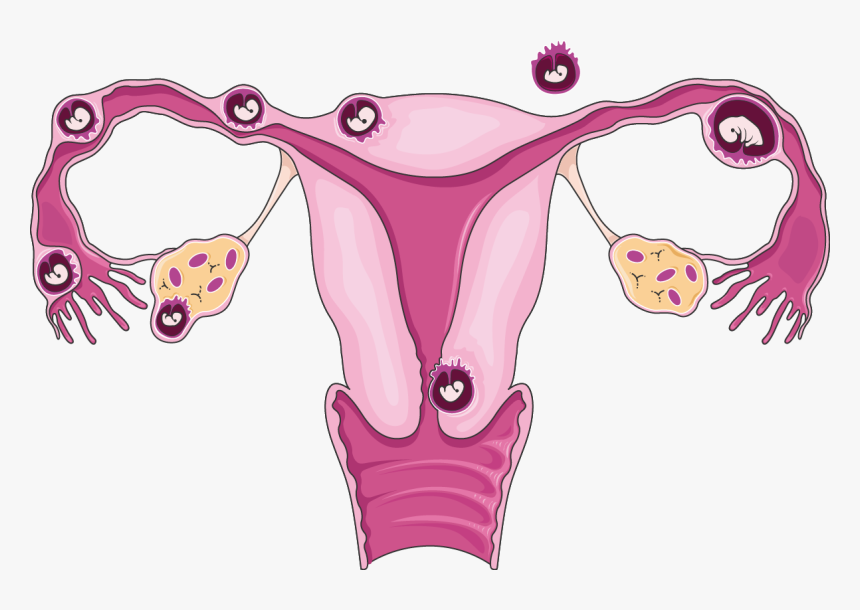 Download The Image - Ectopic Pregnancy Clipart, HD Png Download, Free Download