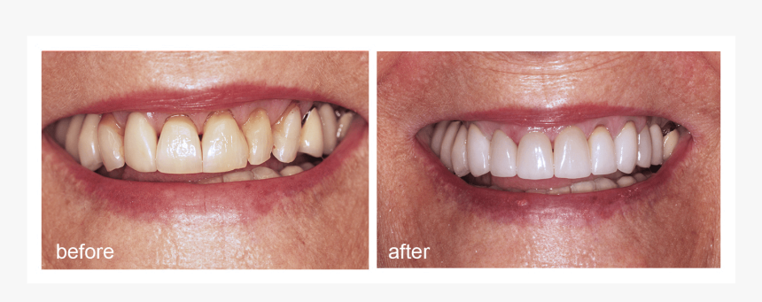 Shot Of Before And After Visiting Abington Smile Gallery - Aggression, HD Png Download, Free Download