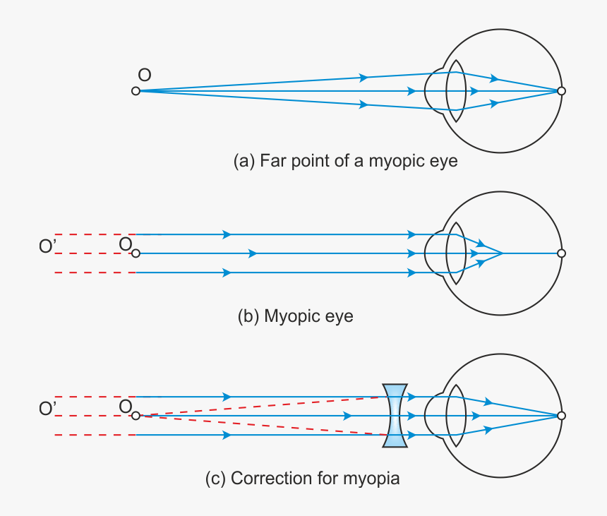 Defects Of Human Eye, HD Png Download, Free Download