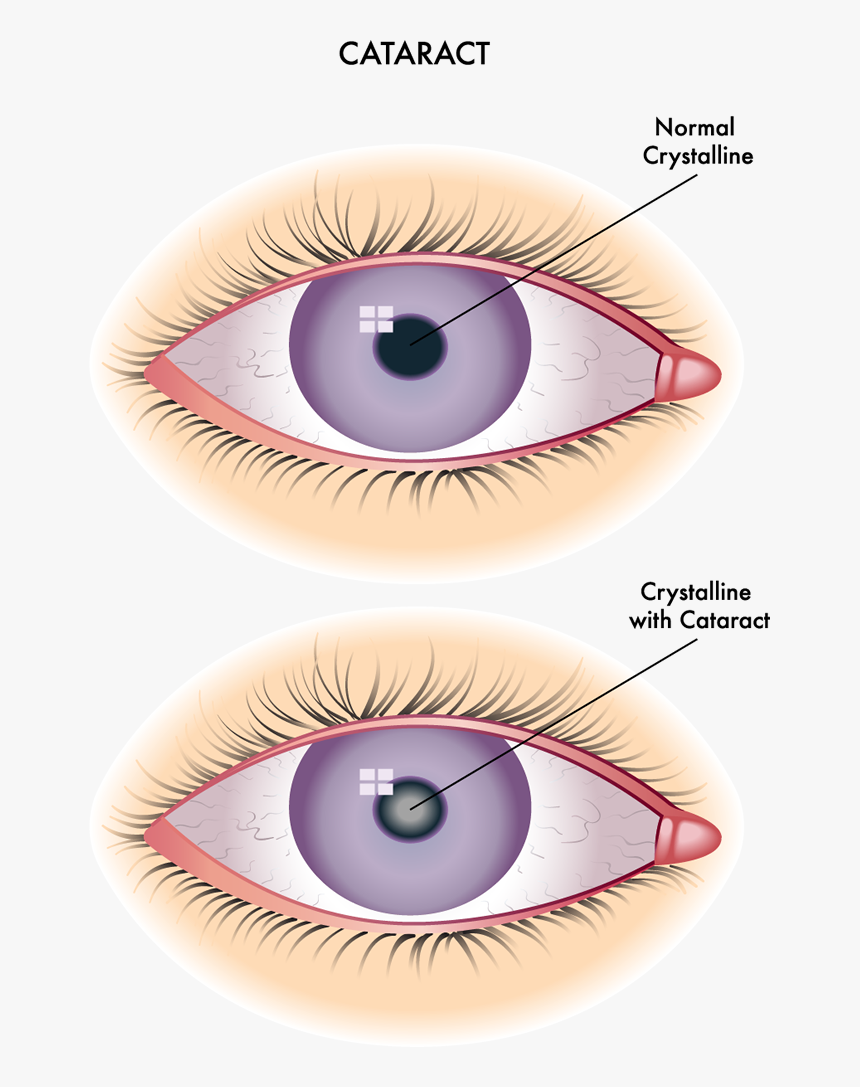 Difference Between Corneal Opacity And Cataract, HD Png Download, Free Download