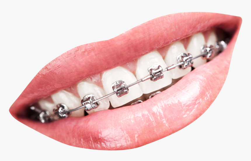 Teeth With Braces Png, Transparent Png, Free Download