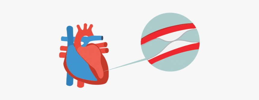 Coronary Heart Disease Treatment And Prevention India - Heart Model Red And Blue, HD Png Download, Free Download