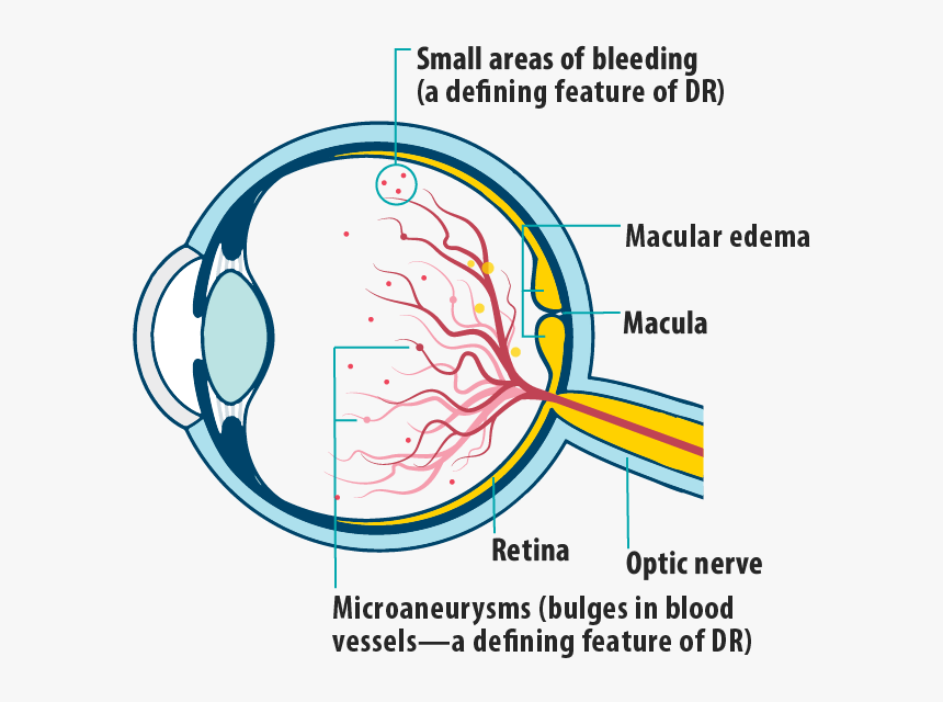 Picture Of Effects Of Diabetic Retinopathy On The Eye, - Central Retinal Vein Occlusion Diagram, HD Png Download, Free Download