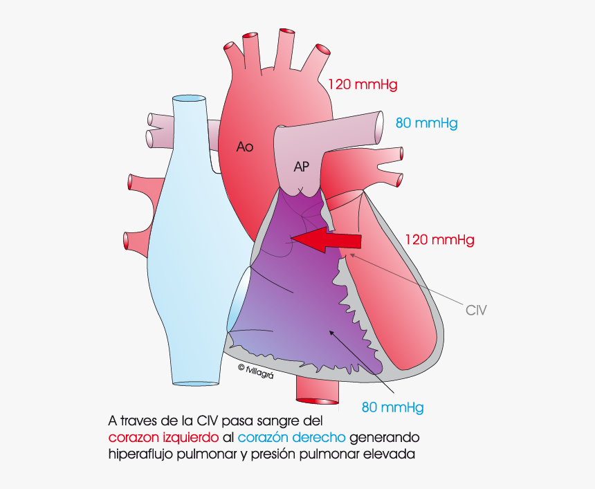 Hipertensión Pulmonar Persistente Del Recién Nacido, HD Png Download, Free Download